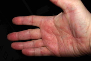 Inflamed Right Hand